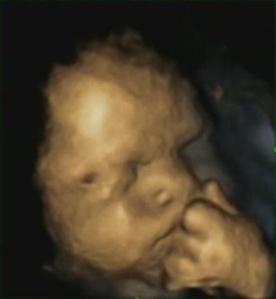 Fetus at 32 Weeks (1)