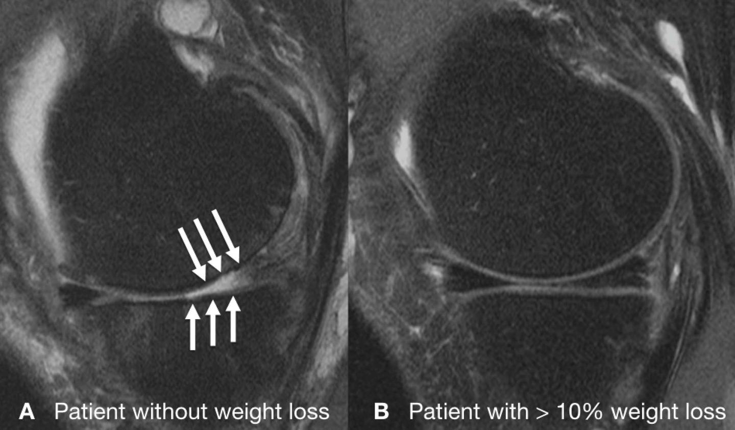 Weight Loss Through Exercise Alone Does Not Protect Knees (2 of 3)