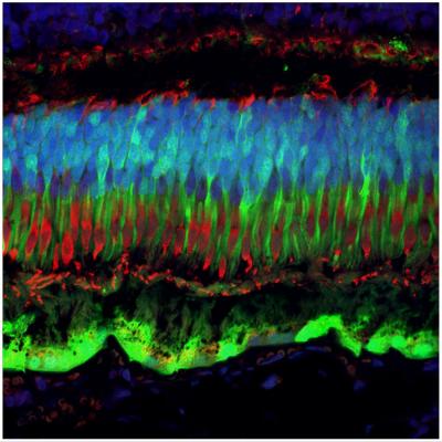 Gene Therapy to Treat Blindness: Finding the Right Dose (1 of 4)