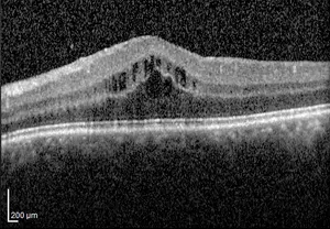 Macular Edema