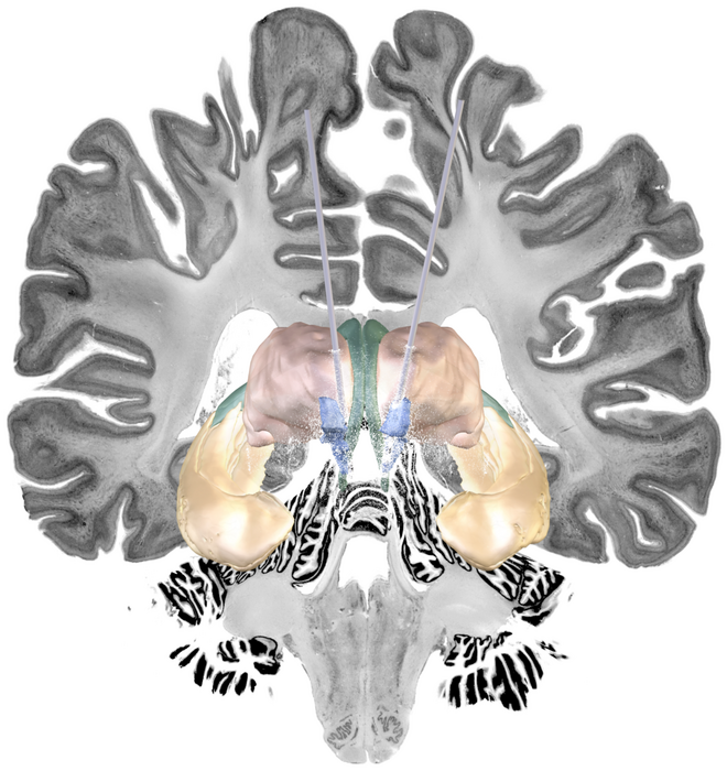 Deep brain stimulation for Alzheimer's disease