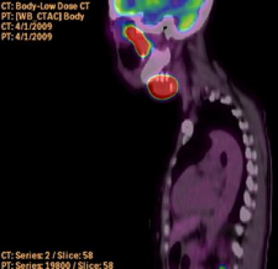 Head and Neck Cancer