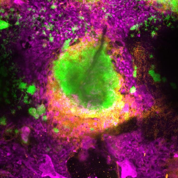 A biofilm formed by two Pseudomonas aeruginosa strains (chronic-like in green, acute-like in orange) growing inside the airway epithelium (magenta).