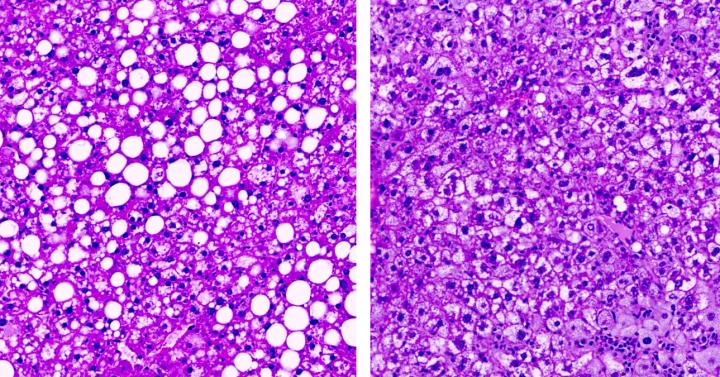 Lowering Ceramides Reverses Signs of Prediabetes