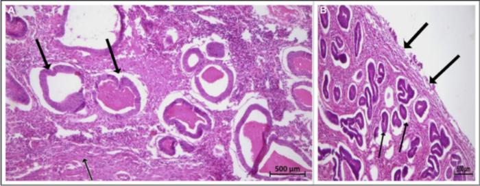 Diffuse cystic adenomyosis simulating invasive uterine neoplasm on imaging: A postmenopausal diagnostic perplexity!