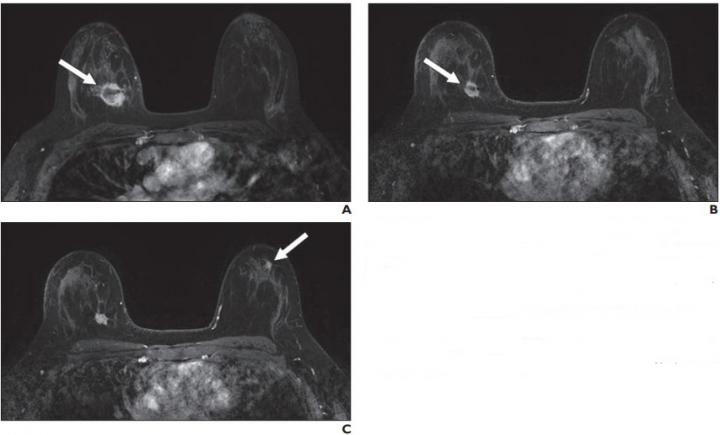 35-Year-Old Woman With Biopsy-Proven Right Breast Invasive Ductal Carcinoma