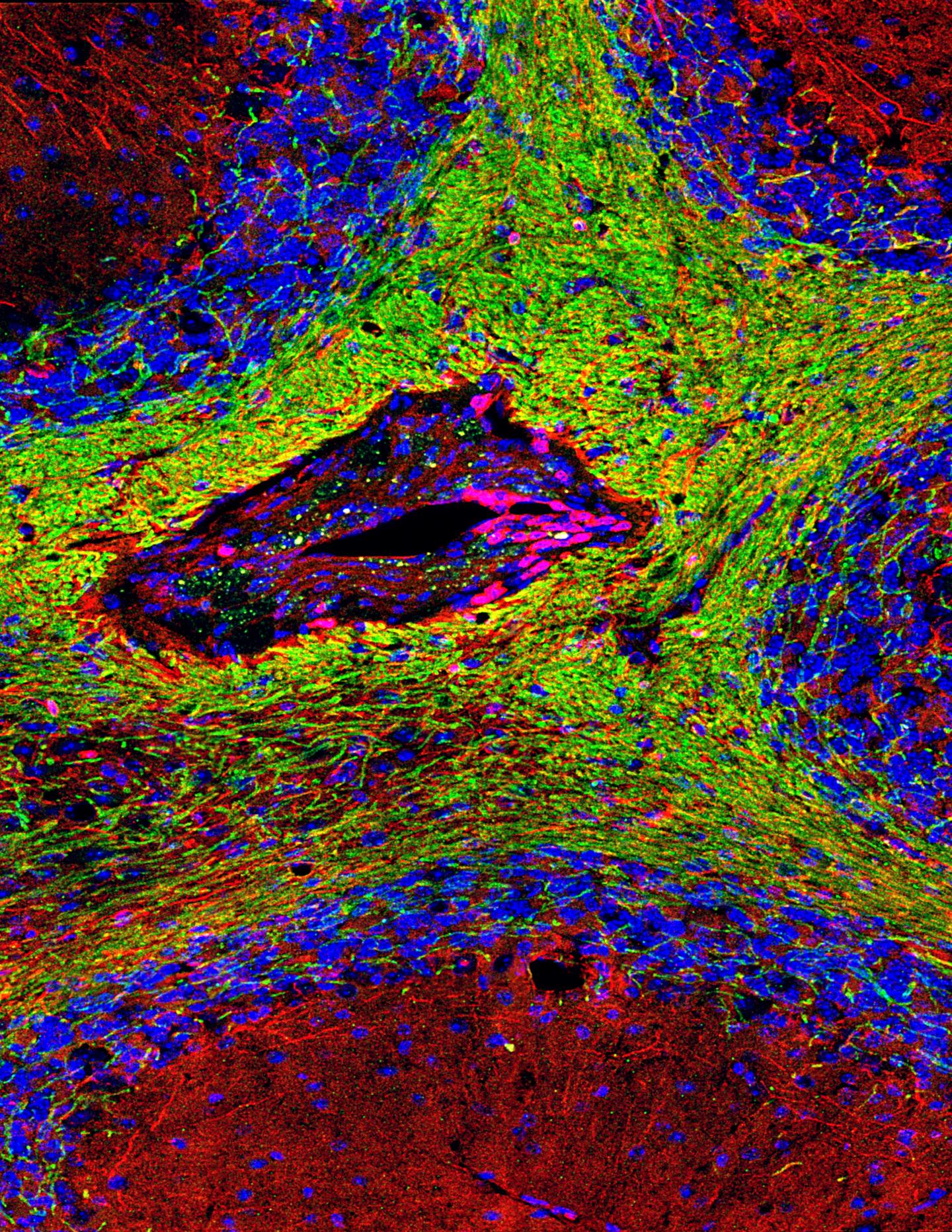 Brain cell death is a possible trigger of mul EurekAlert!