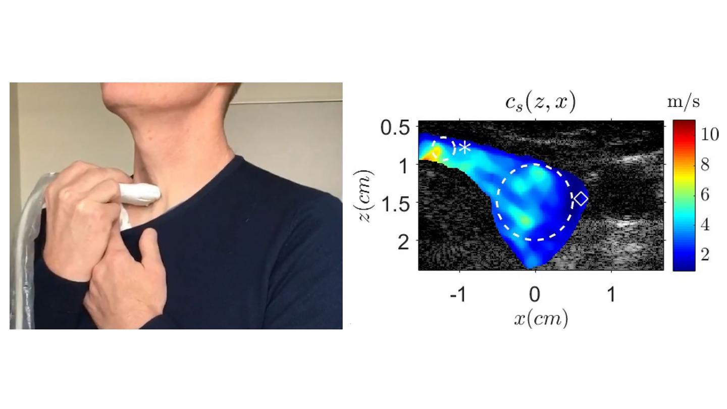 Measuring shear wave speed in a volunteer's thyroid