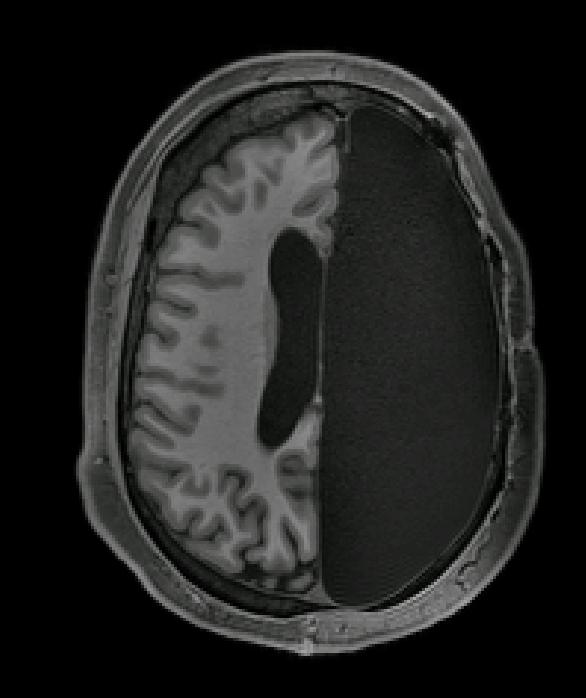 fMRI Scan of Adult with One Hemisphere Removed