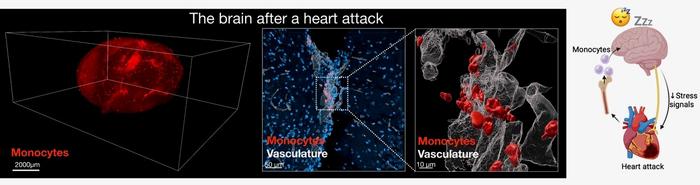 Images of monocytes in the brain after a heart attack and schematic of the findings