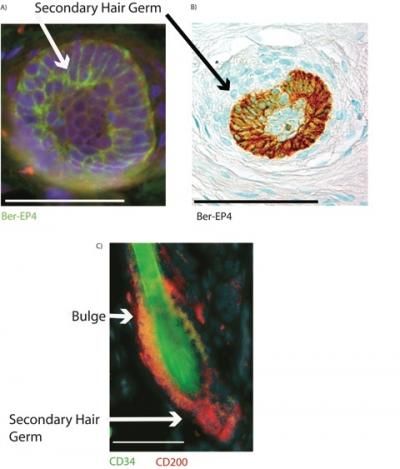 Male Pattern Balding May Be Due to Stem Cell Inactivation