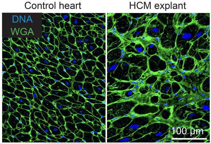 Muscle cells in a heart from a healthy person and a pati?nt with hypertrophic cardiomyopathy
