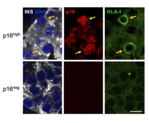 Senescent beta cells show high levels of proteins that display antigens to the immune system