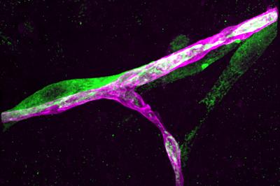 Cancer Cell Hugs a Blood Vessel in the Brain