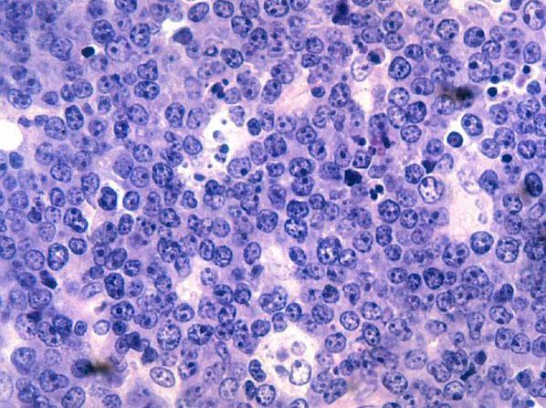 Burkitt Lymphoma