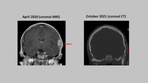 In Brief: Surgery May be Avoided for Children with Rare Skull Tumor