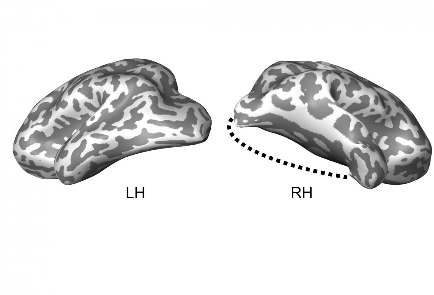 Case Study: Child's Lobectomy Reveals Brain's Ability To Reorganize Its Visual System
