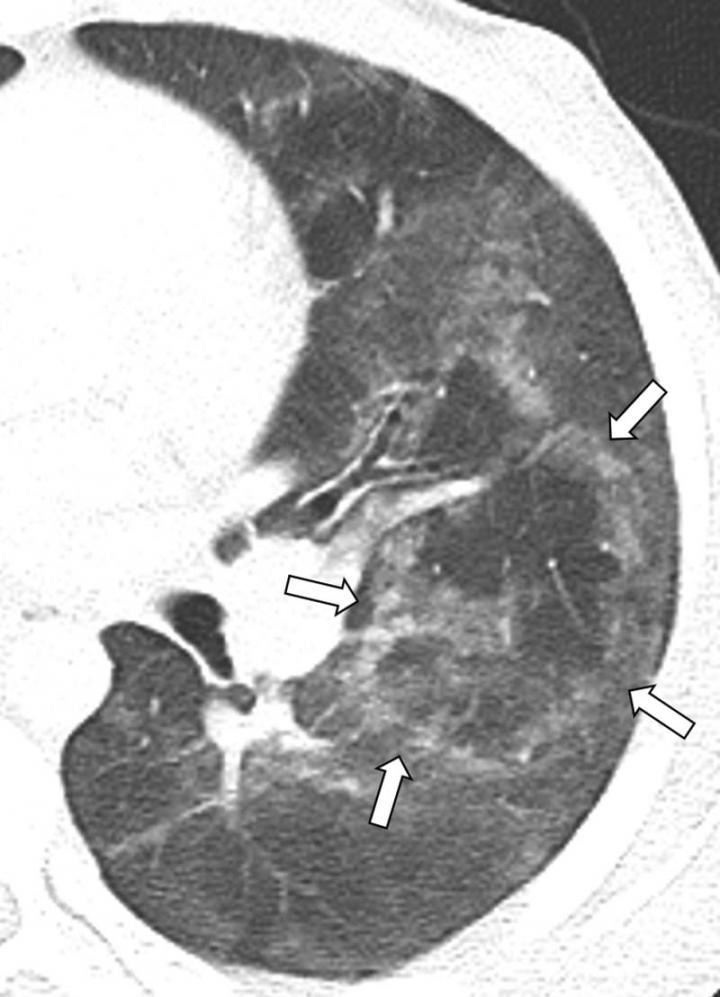Study Looks at EVALI Findings in Teens (2 of 3)