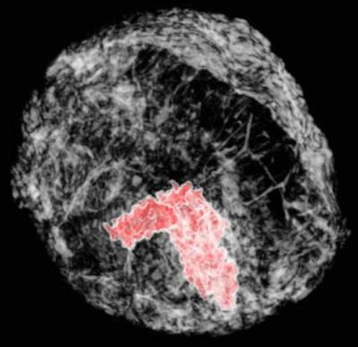 Breast Tumor Imaged in 3-D