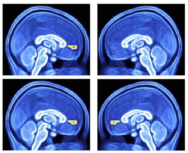 Scientists Succeed in Testing Potential Brain-based Method to Diagnose Autism