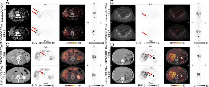 Examples of Lesions in the Same Patients Scanned at 1h p.i. and 3h p.i.