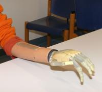 Prosthetic Hand 'i-LIMB' From the Scottish Company 'Touch Bionics'