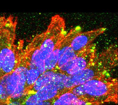 Breast Cancer Cells in 3-D Culture