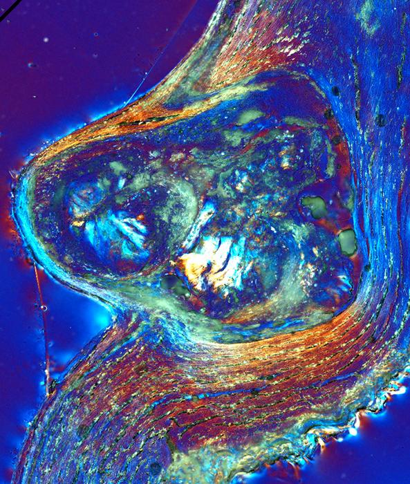 ACP nodule encased in collagen