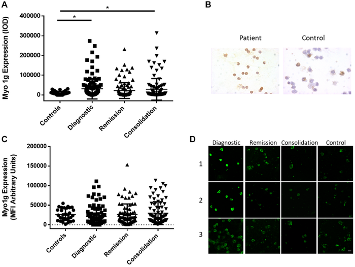 Myo1g over expression is conserved at protein level in acute lymphoblastic leukemia
