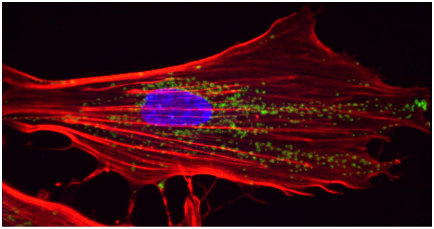 Fibroblast from the Skin of a Patient with Cockayne Syndrome