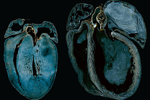 Heart Failure Caused By Energy Production Deficiency