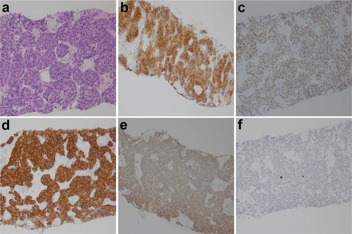 Typical carcinoid tumor