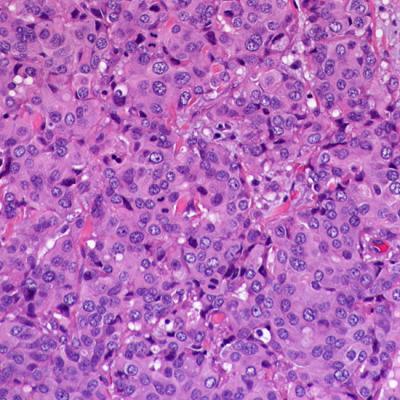 Invasive Ductal Carcinoma