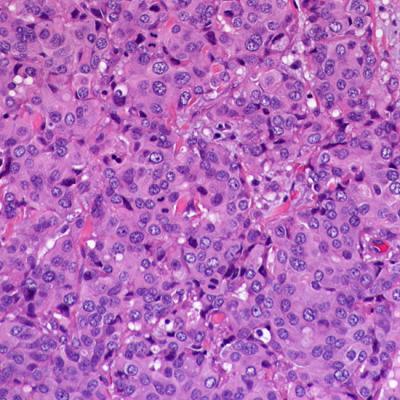 Invasive Ductal Carcinoma [IMAGE] | EurekAlert! Science News Releases