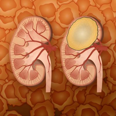 Cancer Stem Cells Isolated from Kidney Tumors