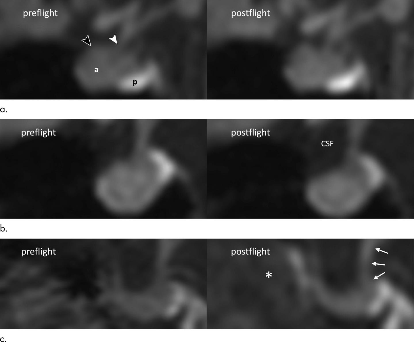 Long Spaceflights Affect Astronaut Brain Volume