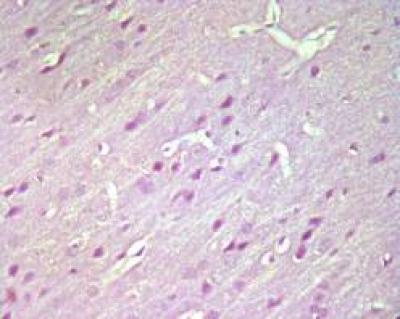 Atorvastatin Pretreatment