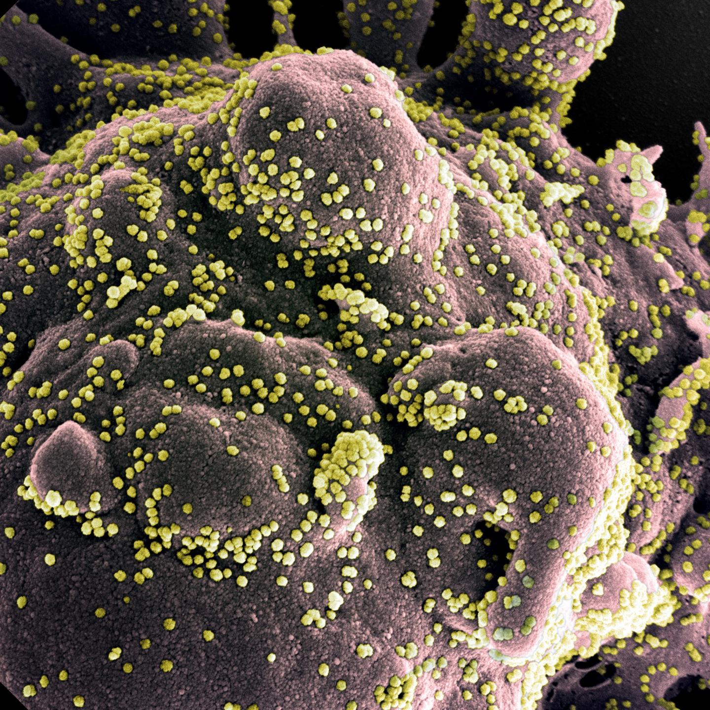 A transmission electron micrograph showing SARS-CoV-2 virus particles