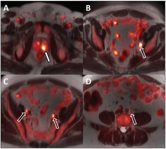 64-year-old man with biopsy-proven Gleason 4+5 in the left base and serum prostate specific antigen