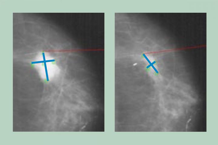 New Study Shows Breast Tumors Evolve in Response to Hormone Therapy