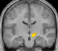 Activation of the Subthalamic Nucleus