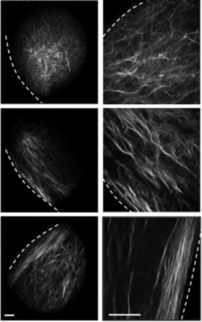 Discovery Helps Show How Breast Cancer Spreads