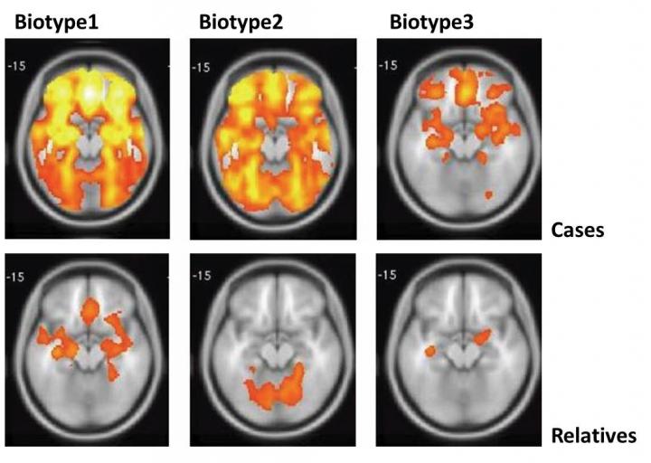 schizophrenia brain scan