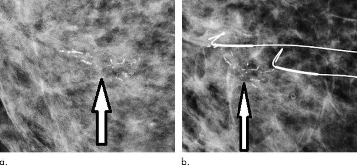 Digital Mammography Increases Breast Cancer Detection