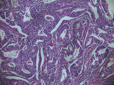 Microscopic Image of a Colon Cancer