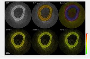 Intravascular FLIM and OCT imaging