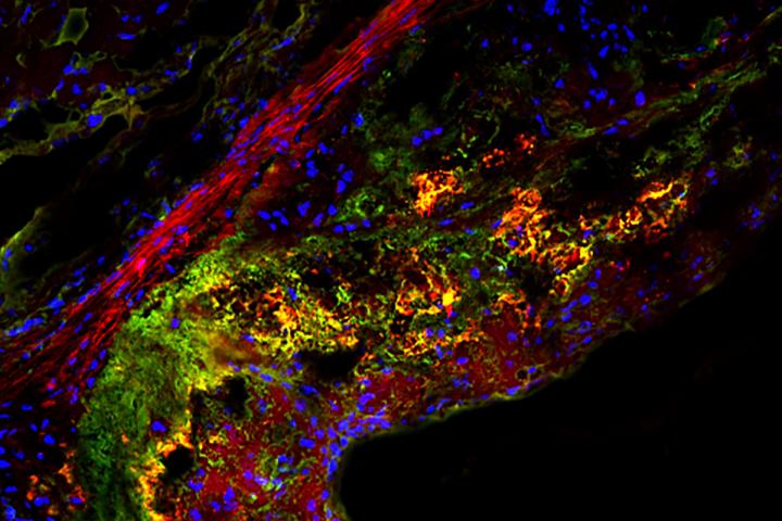 Type of Sugar May Treat Atherosclerosis, Mouse Study Shows