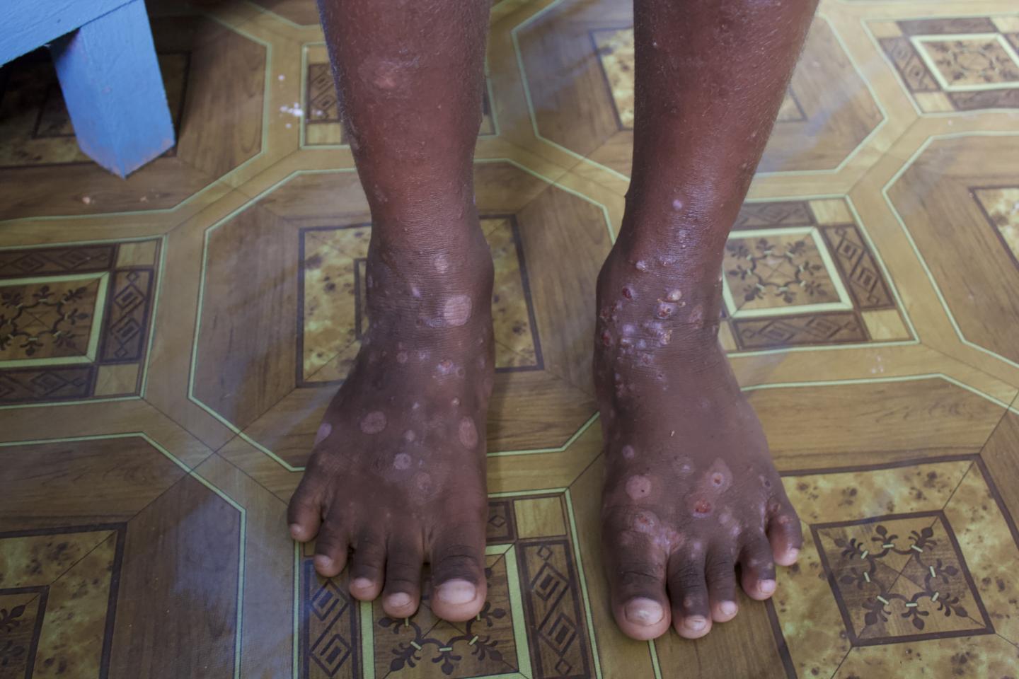 Mild Scabies On Feet