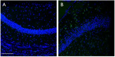 Inflammation and Epilepsy in TSC