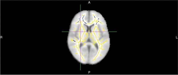 MRI Image in Alzeimer's Patient